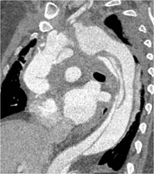 Type B Dissection - CTisus CT Scan