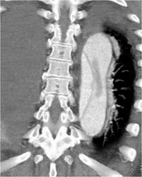 Type B Dissection - CTisus CT Scan