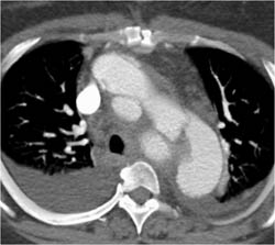 Focal Ulceration Off the Arch - CTisus CT Scan