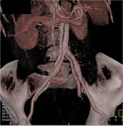 Type B Dissection Into the Iliac Arteries - CTisus CT Scan