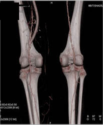 SFA to Popliteal Bypass Graft - CTisus CT Scan