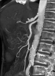 Focal Aneurysm Celiac Artery - CTisus CT Scan