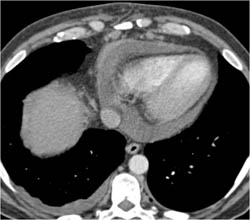 Pericardial Effusion - CTisus CT Scan