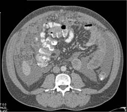 Pericardiac Nodes and Ascites - CTisus CT Scan