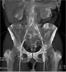 Dilated Focal Superficial Femoral Artery (SFA) - CTisus CT Scan