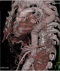 Aortic Aneurysm S/P Repair - CTisus CT Scan