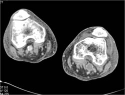 Thrombosed Popliteal Artery on Left - CTisus CT Scan