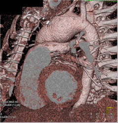 Ascending Aorta Aneurysm - CTisus CT Scan