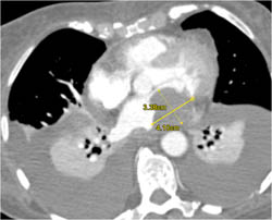 Metastatic Lesion in Left Atrium - CTisus CT Scan