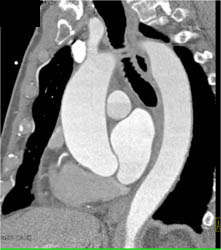 Dilated Ascending Aorta - CTisus CT Scan