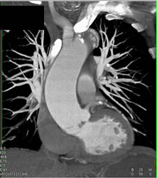 Dilated Ascending Aorta - CTisus CT Scan