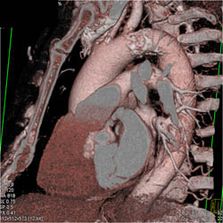 Dilated Ascending Aorta - CTisus CT Scan