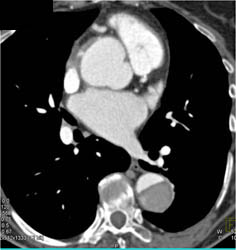 Type B Dissection - CTisus CT Scan