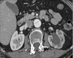 Type B Dissection With Left Renal Artery Off False Lumen - CTisus CT Scan