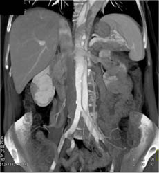 Type B Dissection - CTisus CT Scan