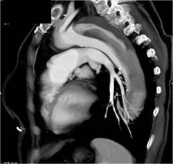 Type B Dissection - CTisus CT Scan