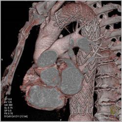 Endovascular Stent in Place - CTisus CT Scan