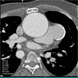 Aneurysm Off Pulmonary Trunk - CTisus CT Scan