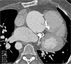 Marfan S/P Root Repair - CTisus CT Scan