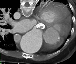 Dilated LAD With Calcification - CTisus CT Scan