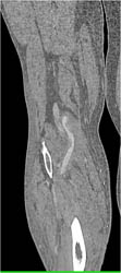 Bypass Grafts to Calf Are Patent - CTisus CT Scan