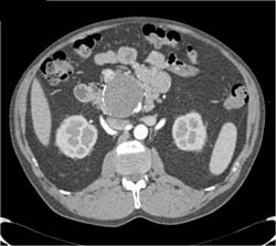 Hepatic Artery Aneurysm - CTisus CT Scan