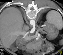 Hepatic Artery Aneurysm - CTisus CT Scan