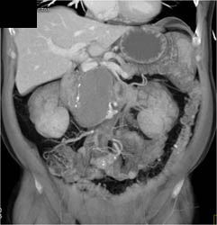 Hepatic Artery Aneurysm - CTisus CT Scan