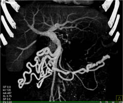 Occlusion of Splenic Artery With Collaterals - CTisus CT Scan