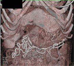 Cirrhosis With Varices - CTisus CT Scan