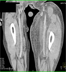 Swollen Left Venous System - CTisus CT Scan