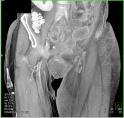 Nodes Compress the Left SFA - CTisus CT Scan