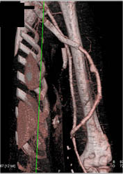 Patent Bypass Stent - CTisus CT Scan