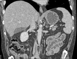 Fluid Under Surface of Liver - CTisus CT Scan