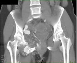 Pelvic Arteriovenous Malformation (AVM) Erodes Bone - CTisus CT Scan