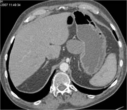 Splenic Artery Aneurysm Simulates A GIST Tumor on Non-contrast Ct - CTisus CT Scan