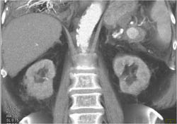 Splenic Artery Aneurysm - CTisus CT Scan