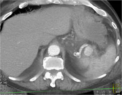 Splenic Artery Aneurysm - CTisus CT Scan