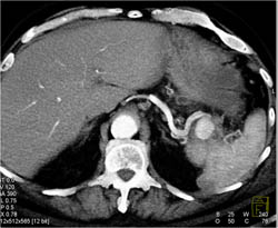 Splenic Artery Aneurysm - CTisus CT Scan