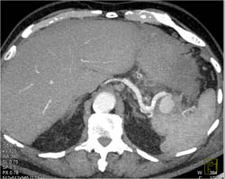 Splenic Artery Aneurysm - CTisus CT Scan