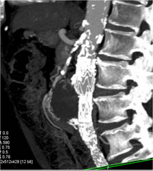 Endovascular Stent Without Leak - CTisus CT Scan