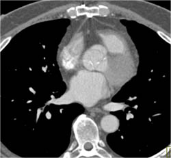 Calcified Aortic Valve - CTisus CT Scan