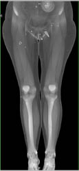 Runoff Without Abscess - CTisus CT Scan