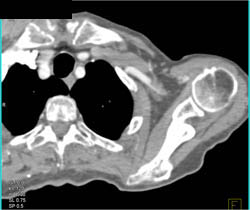 Clot in Axillary Vein - CTisus CT Scan