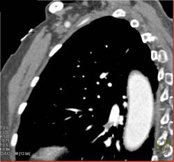 Pulmonary Embolism - CTisus CT Scan