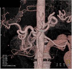 Median Arcuate Ligament Syndrome - CTisus CT Scan