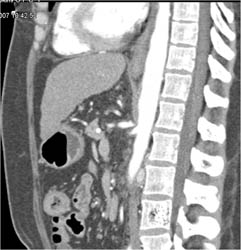 Median Arcuate Ligament Syndrome - CTisus CT Scan