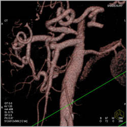 Median Arcuate Ligament Syndrome - CTisus CT Scan