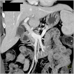 Prominent Imv - CTisus CT Scan