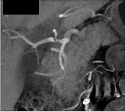 Hepatic Artery Stenosis in Liver Transplant Patient - CTisus CT Scan